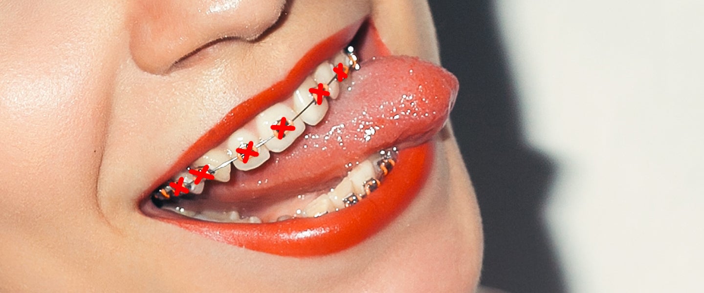 Braces girl from twitter full video