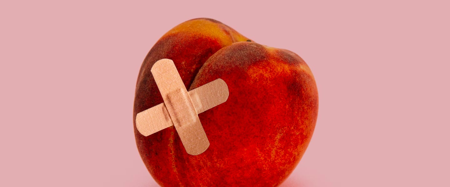 Can Anal Sex Cause Hemorrhoids?