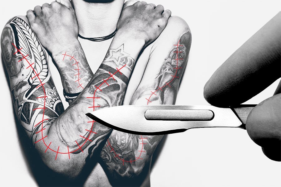 As Tattoos Become More Popular, Surgeons Are Altering Their Techniques