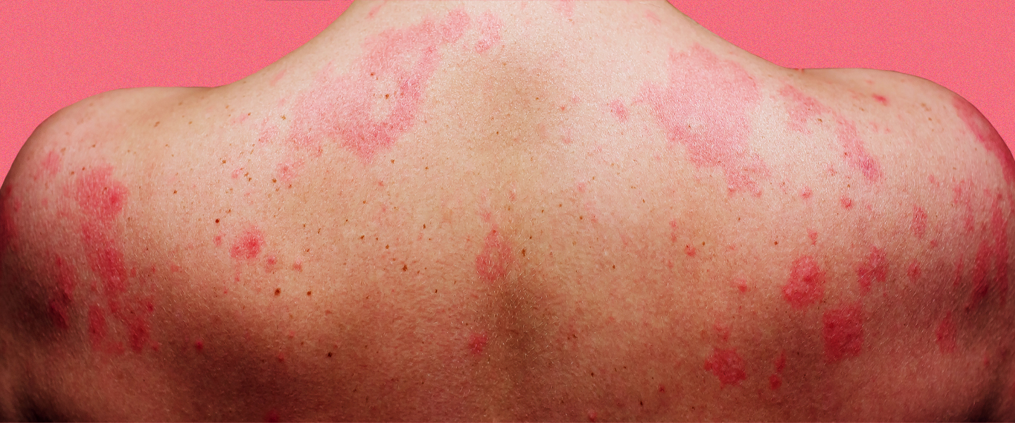 What Are Stress Hives and Rashes, How Do I