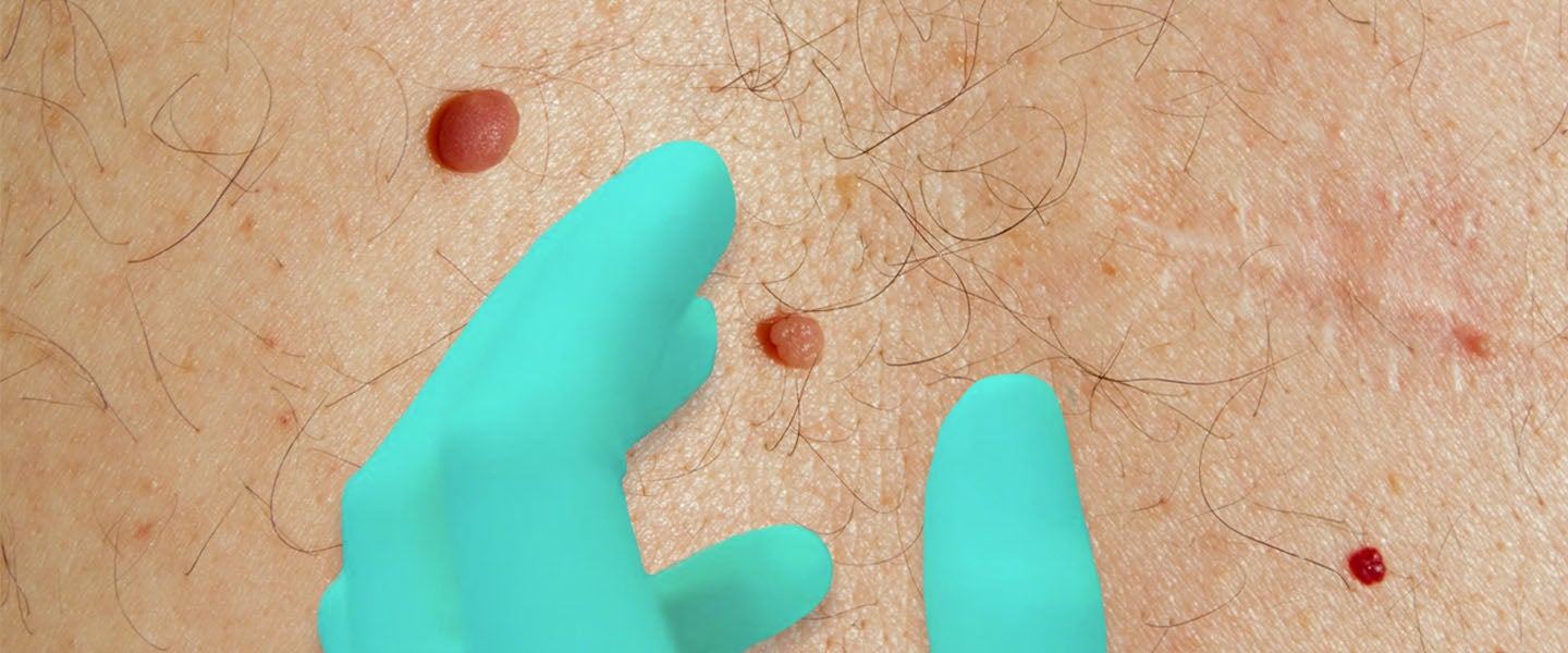 What Kind of Mole Is a Mole I Need to Worry About?