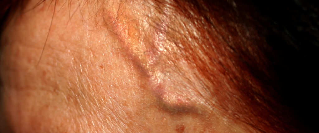 How to treat a bulging forehead vein? Surgery can be extremely risky — but you do have a few options