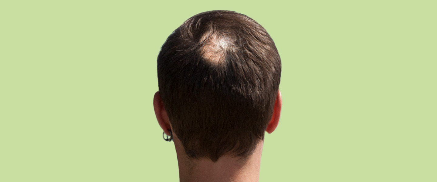 Regaine - What are the facts about hair loss?