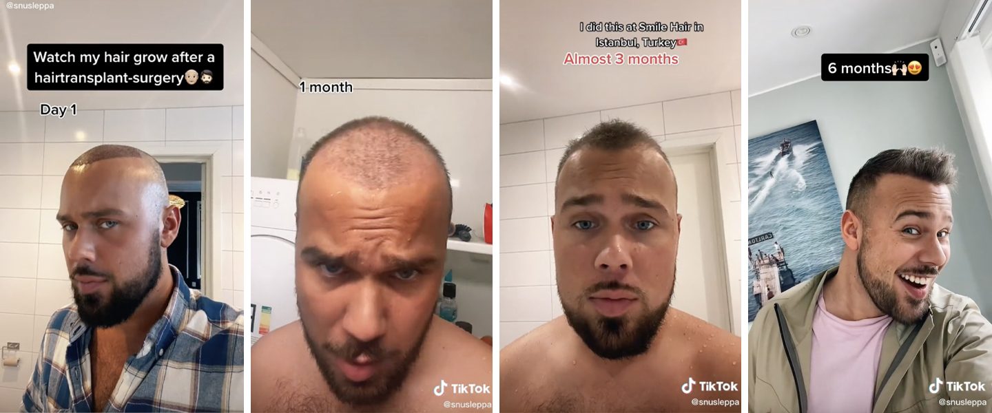 Hair Transplant Before and After Stories on TikTok